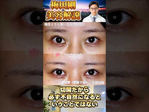医学科 埋没法は自然？切開は不自然？果たして本当にそうなのか？ #うめだ美容外科クリニック #美容整形 #埋没法