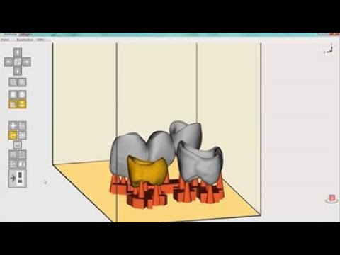 Nesting of Temporary Crowns and Bridges