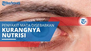 Mengenal Xerophthalmia, Penyakit Mata yang Bisa Sebabkan Kebutaan karena Kurangnya Nutrisi