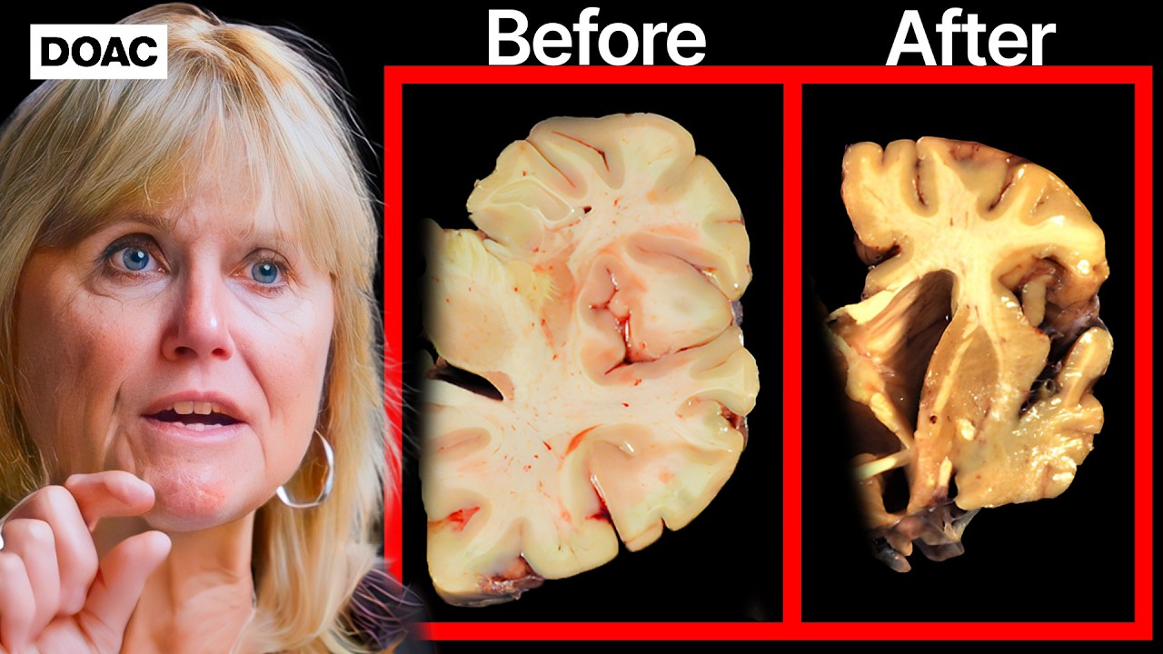 THIS Is The Fastest Way To Get Dementia… |  The Brain Doctor, Dr Ann Mckee