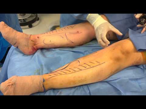 download lagu mp3 mp4 Calf Liposuction, download lagu Calf Liposuction gratis, unduh video klip Calf Liposuction