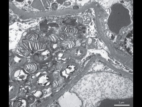 Zebrakörper in der Niere   Morbus Fabry