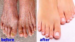 remove wrinkles from legs & feet get younger and fresh looking legs