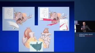 Surgical Pulmonary Vein Isolation/MAZE – Dr Michael Yii