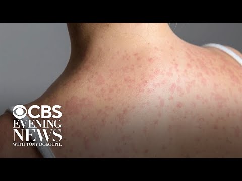 South Carolina measles outbreak explodes to nearly 800 cases