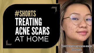 Treating Acne Scars at Home