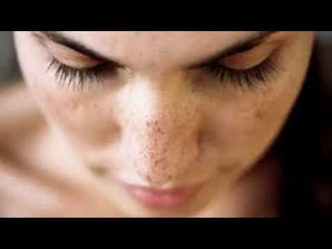 Che fare con pigmentary nota sopra un labbro superiore La decolorazione ubtan per la persona