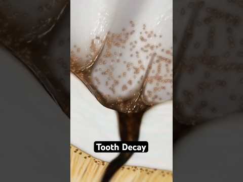 How decay destroys your teeth (3D Animation)
