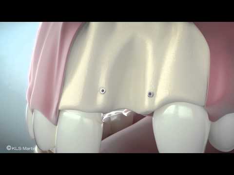 SonicWeld Rx® Dental – Alveolar protector