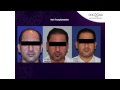 FUE Hair Transplant Surgery at Cocoona Centre