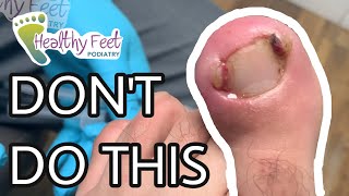 INGROWN NAIL HOME REMEDY GONE BAD!! DO NOT TRY THIS AT HOME
