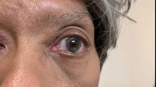 Eyelid Closure Problems after Cosmetic Eyelid Surgery