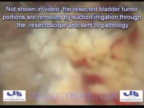 Transurethral Resection Of Bladder Tumor (TURBT) For Bladder Cancer