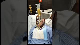 Nasogastric tube feeding || Ryles tube feeding procedure