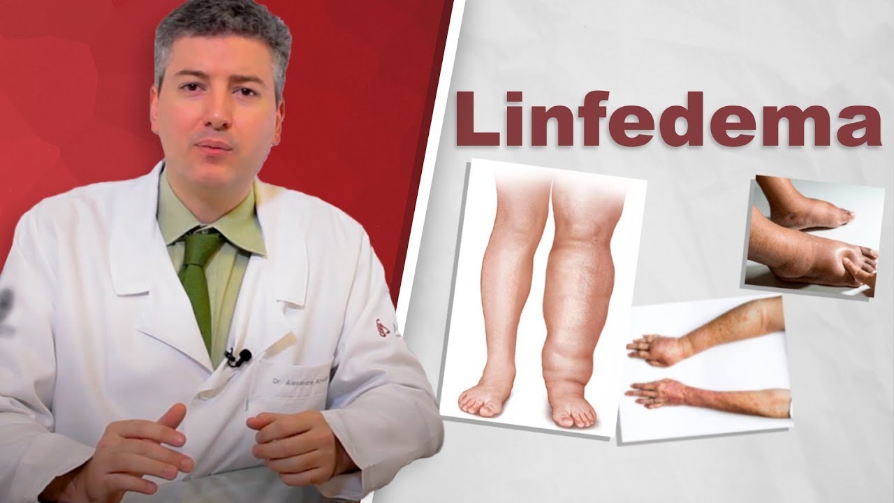 Linfedema: Inchaço das pernas