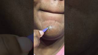 Pimple Patch Chronicles | do they even work?? | beauty with bodden #omg #pimplepatch