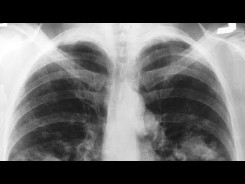 Lung Cancer & COPD in the 9/11 Community Webinar Video Thumbnail