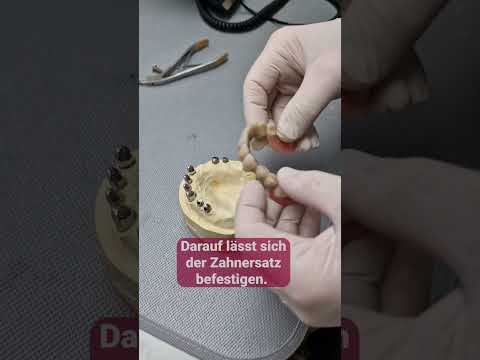 🦷 Teleskop-Technik oder Doppelkronen-Technik leicht erklärt  ℹ️ von unserem Zahntechniker Max Rieck