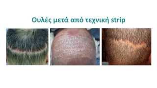 Αποκατάσταση ουλών της μεθόδου FUT - Strip _ Δρ.Αναστάσιος Βεκρής