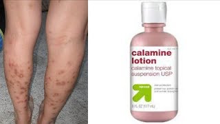 Home Remedies Series || Get Rid of Dark Spots On Legs & Body With Calamine Lotion