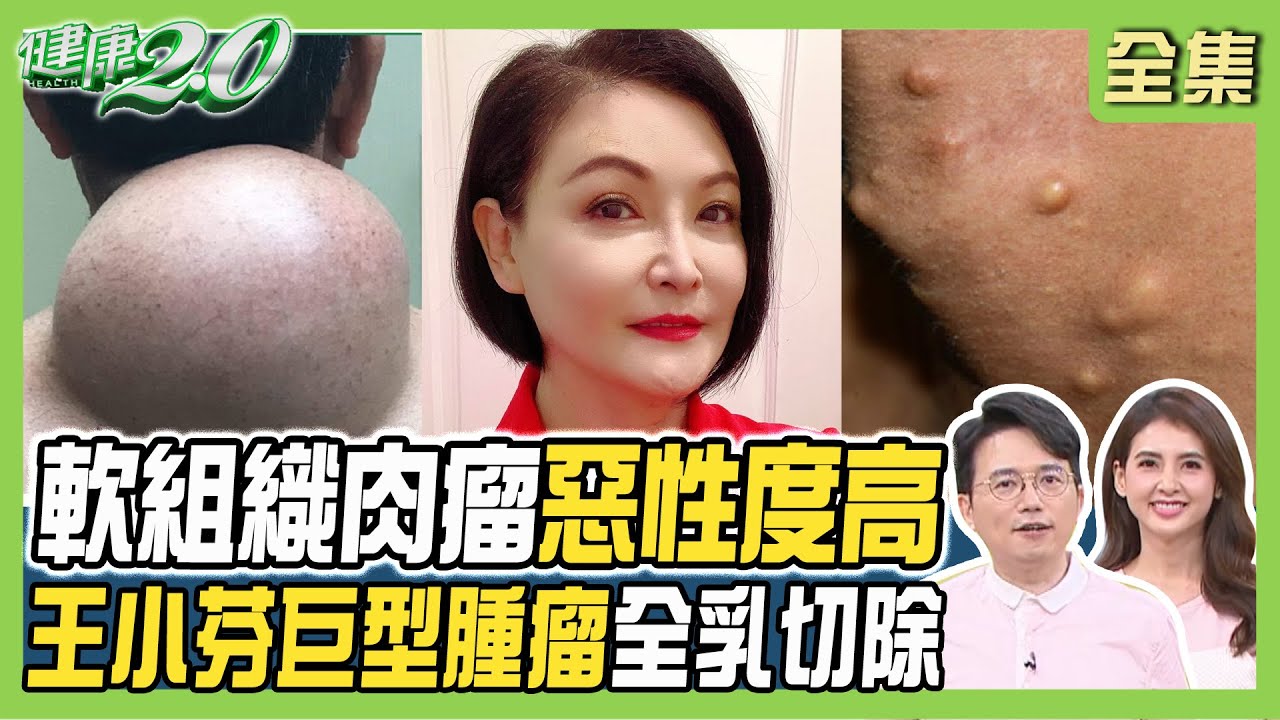 有乳房腫瘤免過度擔心?外科醫:多為良性 出現「4症狀」需開刀