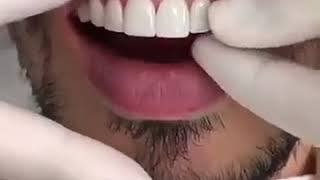 قشور الأسنان Les facettes dentaires