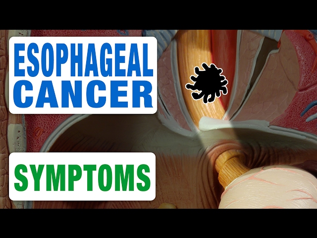 Video Pronunciation of esophageal cancer in English