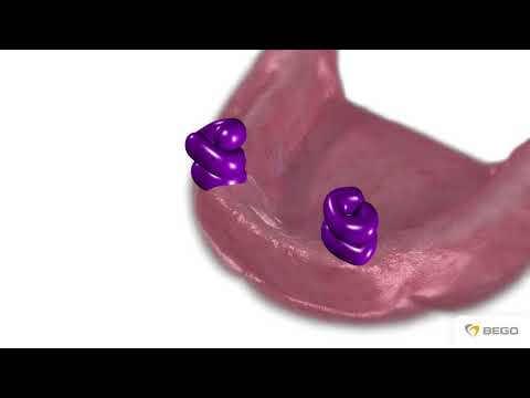 BEGO Semados® Easy-Con System (Laboratory)