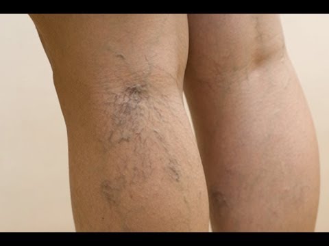 Gel casero de aloe vera para las varices