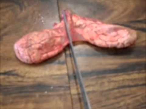 Dopo un corso che della prostata Provoca la crescita di adenoma prostatico