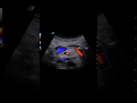 Pancreas – Stones in the Main Pancreatic Duct (Pancreatolithiasis) – Clip 1 B-mode + Color