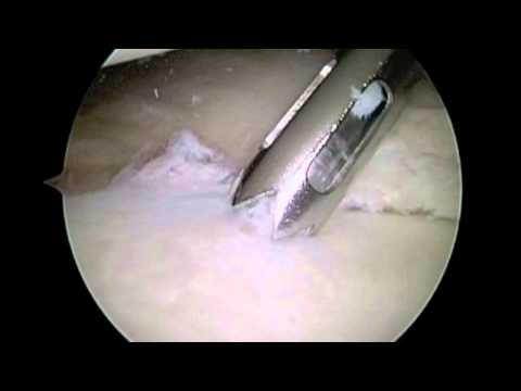 Arthroscopic Bankart Reconstruction