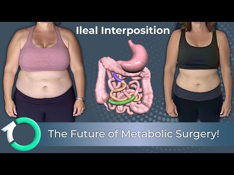 Laparoscopic Ileal Interposition (Type 2 Diabetes Surgery) - Surgical Procedure - One Clinic Patient Review Video