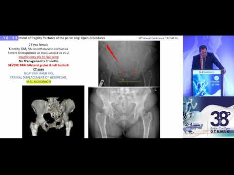 Kanakaris N. - Surgical treatment of fragility fractures of the pelvic ring: Open procedures