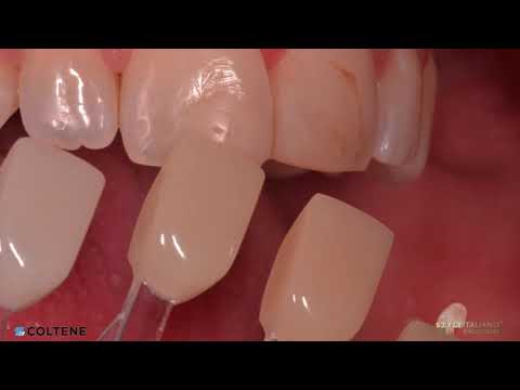 CCC - Monaldo Saracinelli StyleItaliano (Direct anterior single mass restoration) BRILLIANT EverGlow