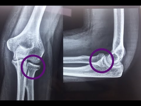 Radial Head or Neck Fracture