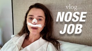 I Got A Nose Job | My Rhinoplasty Experience