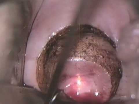 CO2 Laser in gynaecology – Part 1