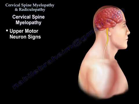 Mielopatia odcinka szyjnego kręgosłupa: objawy, diagnoza, leczenie i nakładające się schorzenia