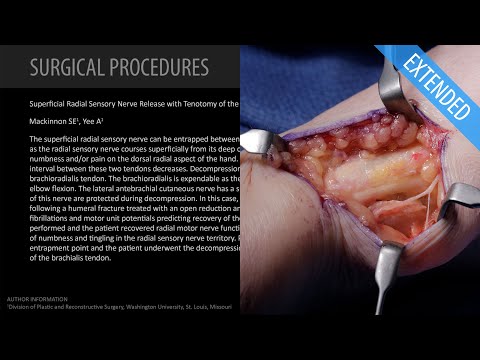 Superficial Radial Sensory Nerve Release - Extended (Feat. Dr. Mackinnon)