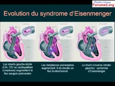 Comment traiter les pieds dans lhypertension Comment améliorer limmunité dibazolom