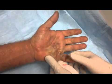 , title : 'Dupuytren's Contracture Treatment with Xiaflex Video #2 (Dr. Kenty Sian)'