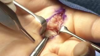 Trigger Finger Release Surgery