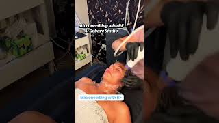 Microneedling with Radiofrequency at Gobare Studio in Worcester, MA #microneedling #worcesterma
