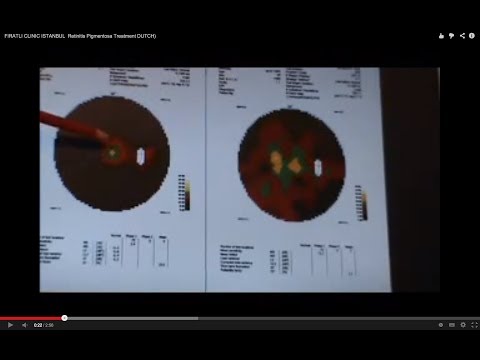 Talat - Holland - Retinitis Pigmentosa Treatment - Part 2 ( Results ) (in Dutch) - Testimonial - Great success 