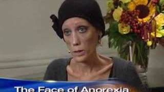 Anorexia&#39;s Living Face (CBS News)