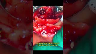 Liver Clot #science