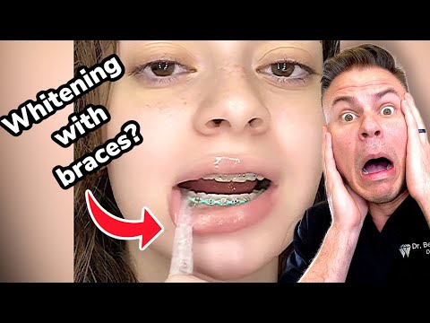 Can You Whiten Teeth With Braces?! Orthodontist Reacts
