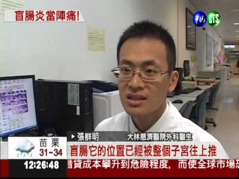 肚疼以為陣痛! 孕婦急性盲腸炎