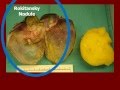 Mature Ovarian Teratoma (incidental) - YouTube